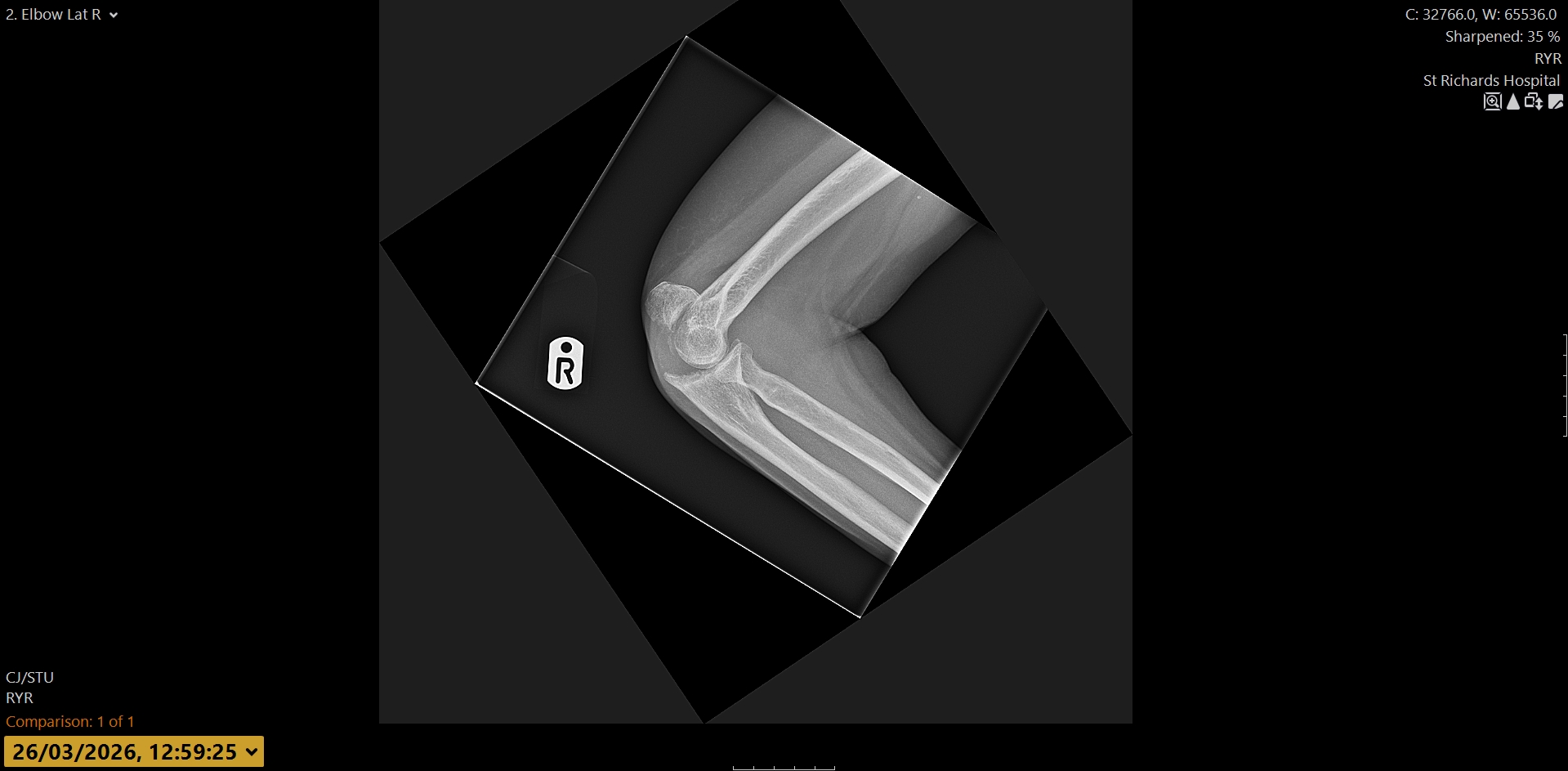 Persisting pain should trigger an X ray request